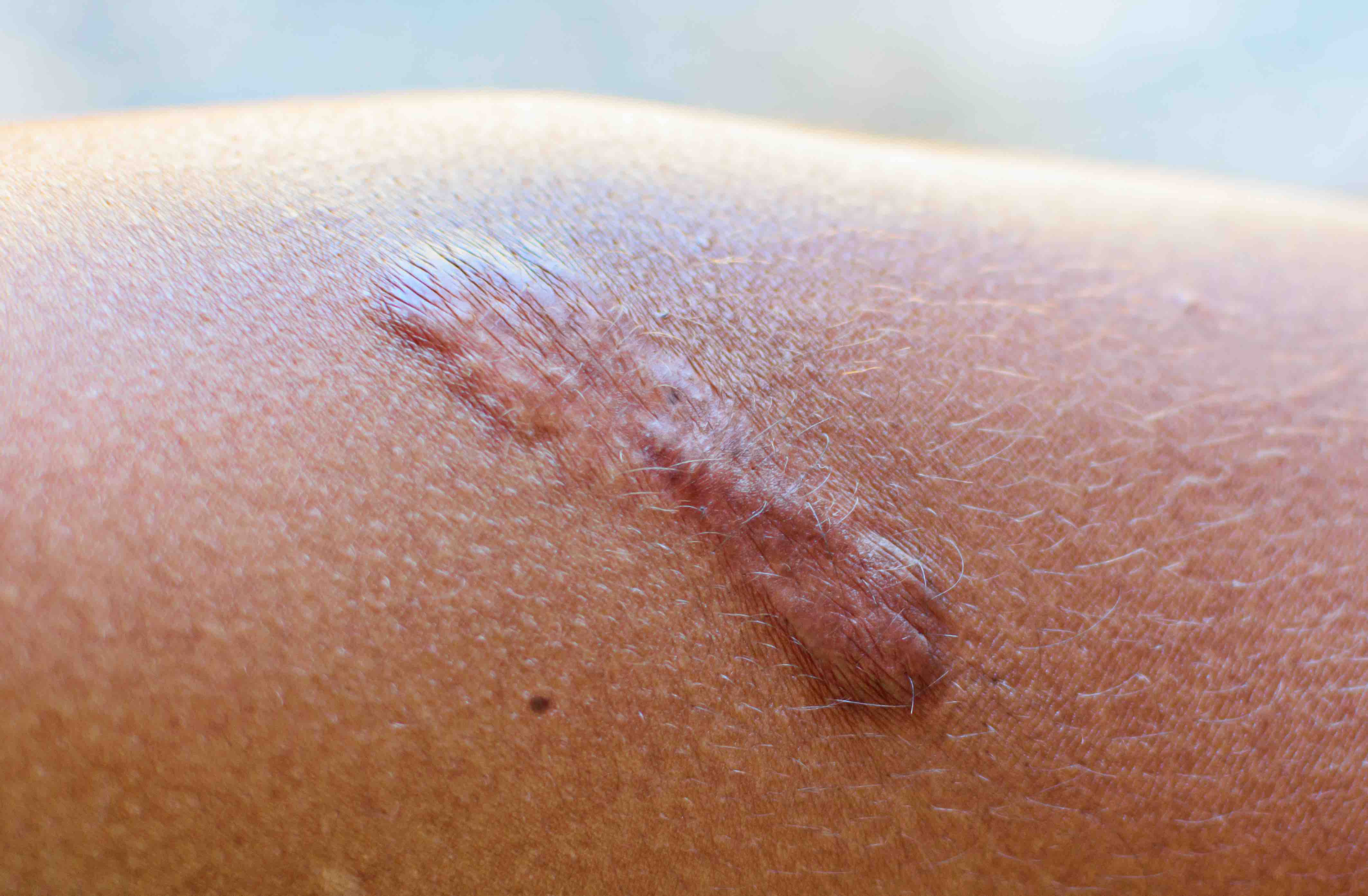 Hypertrophic scar 